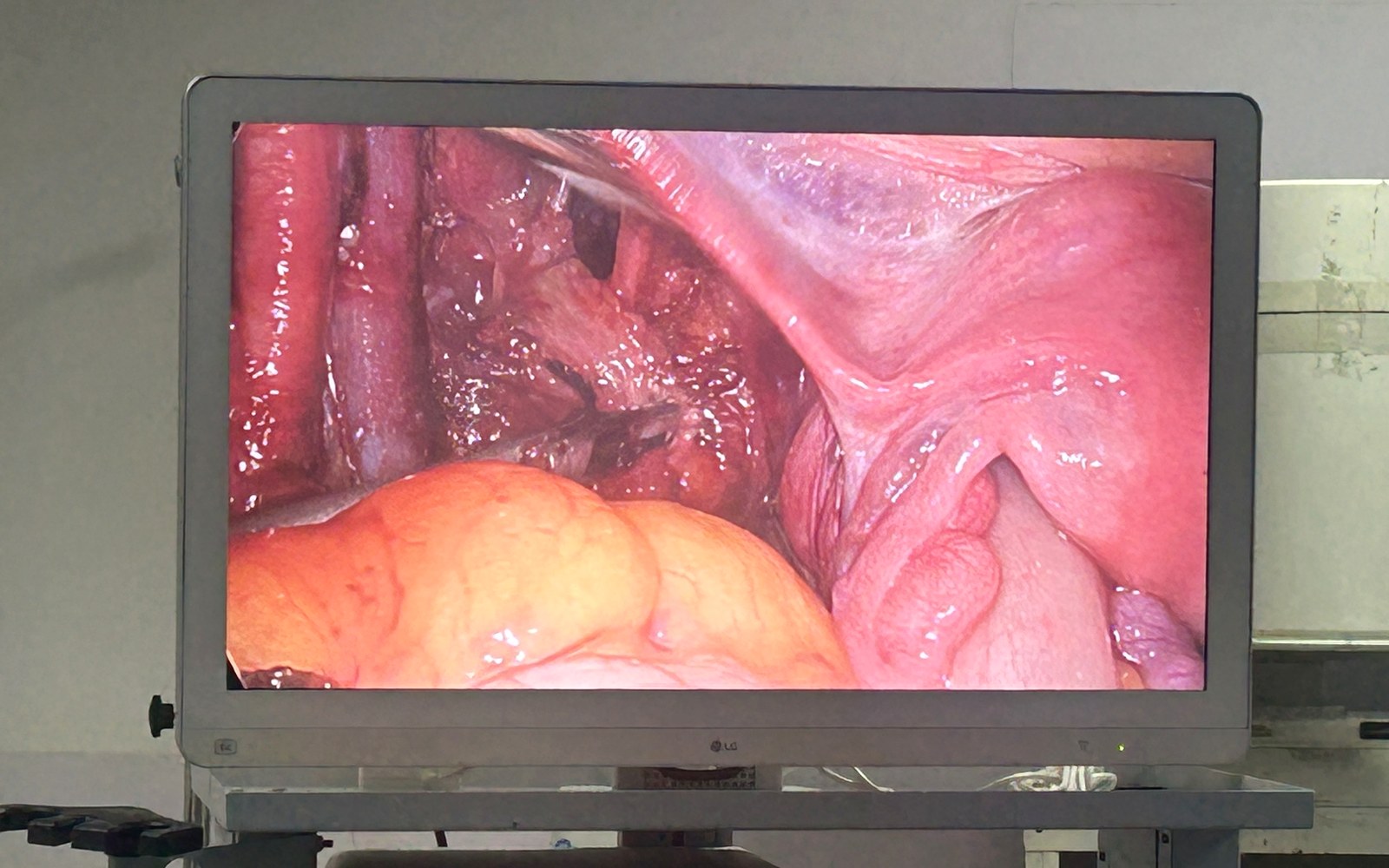 LAVH and TLH laparoscopic hysterectomy update
