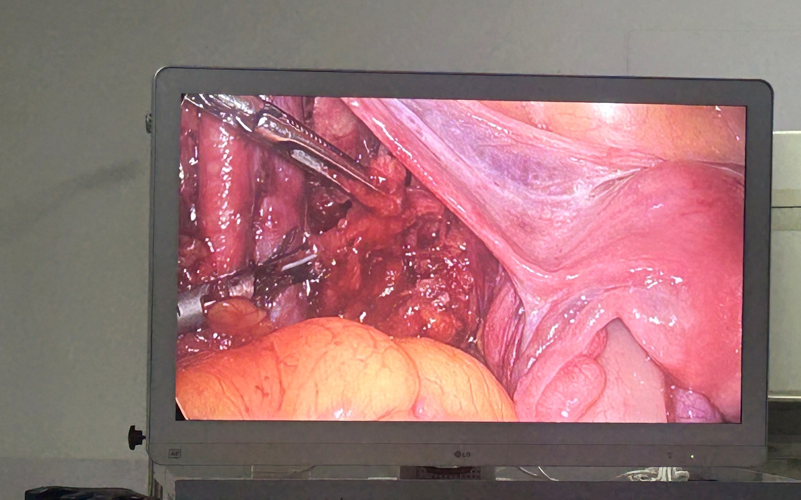 Efficient Laparoscopic Rhythm