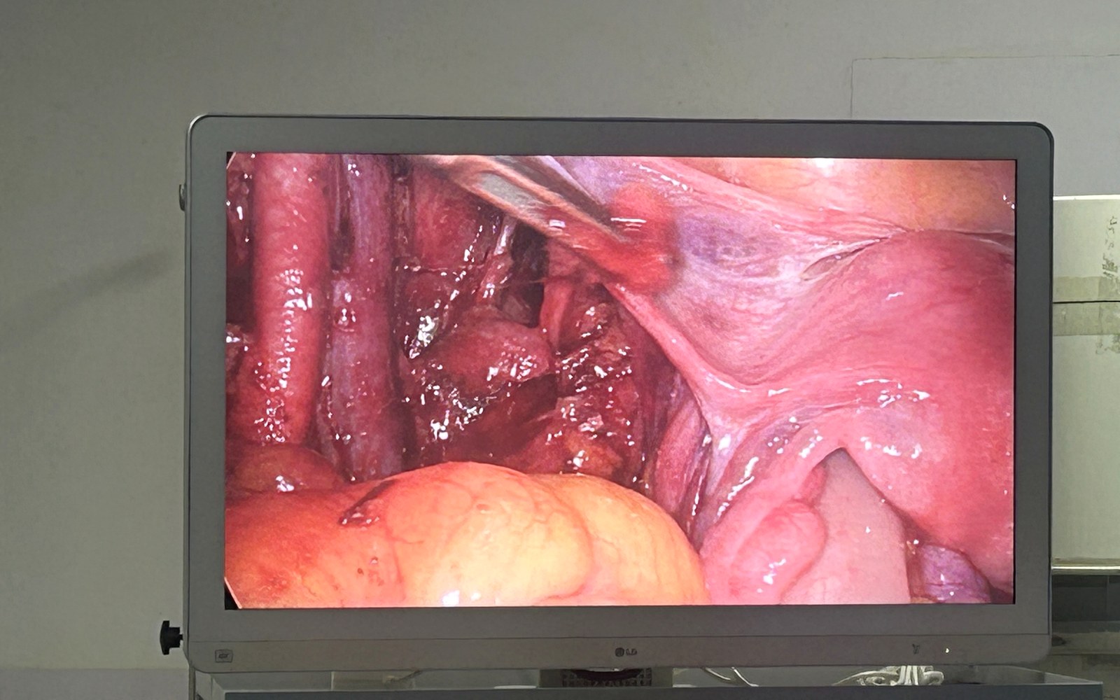 Efficient Laparoscopic Rhythm